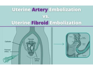Exploring the Power of Uterine Artery Embolization: A Comparative Guide