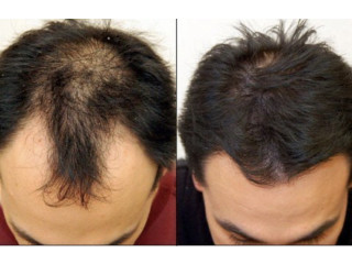 Eminence Look | Hair Replacement Service in Queens NY
