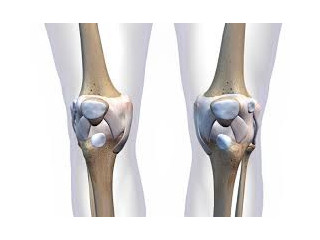 Knee Pain Treatment Specialists In Jericho, NYC