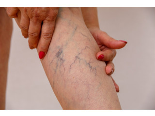 What is a Vein Specialist Called?