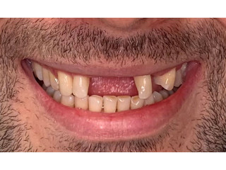 Multiple Teeth Implants | Dental Implants Dentures '