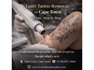 laser-tattoo-removal-in-cape-town-clear-step-by-step-small-0