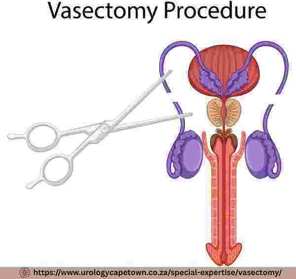 permanent-birth-control-options-for-cape-town-men-big-0
