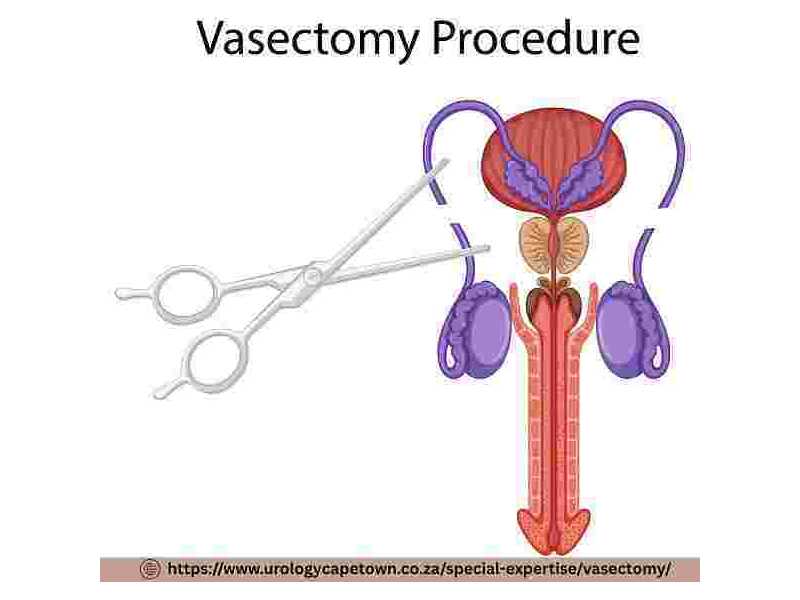 permanent-birth-control-options-for-cape-town-men-small-0